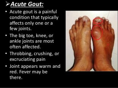 acute gout symptoms